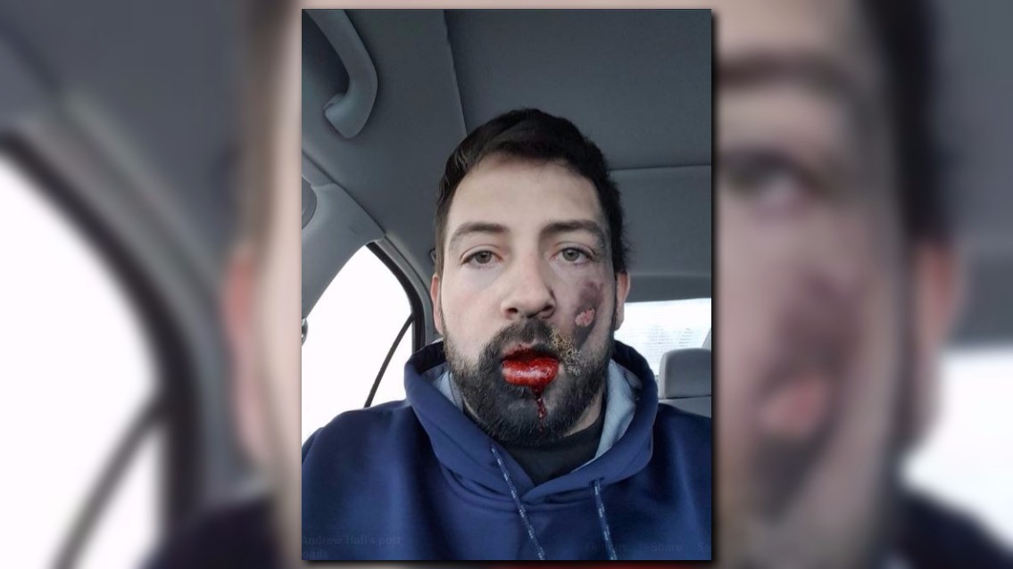 GRAPHIC IMAGES Man hospitalized after vape pen allegedly explodes